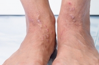 Foot Symptoms of Genodermatoses